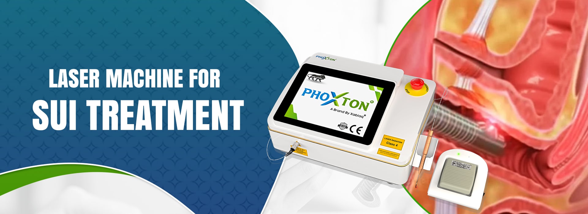 Laser Machine for SUI Treatment in Ahmedabad Laser Machine for SUI Treatment in Ahmedabad